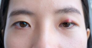 styes