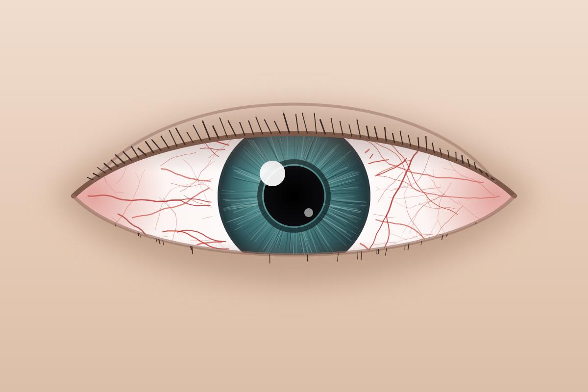 Illustration of an eye with the white of the eye showing dilated red blood vessels across the surface.