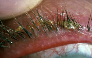 anterior blepharitis