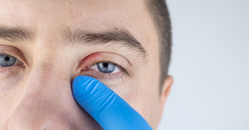 Blepharitis: Symptoms, Causes and How to Treat Inflamed Eyelids