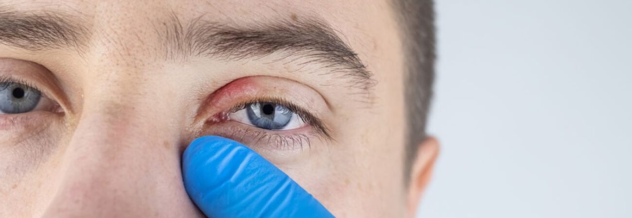 blepharitis